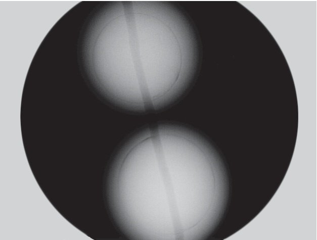 Real-time X-ray microradiography of bead-cultured pearl